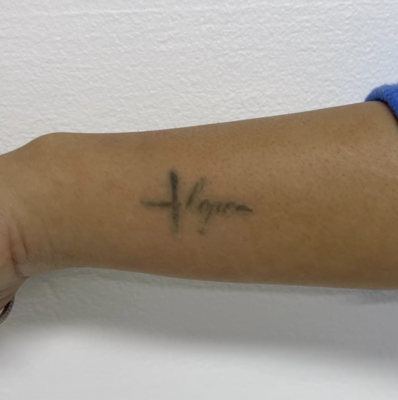 tattoo removal